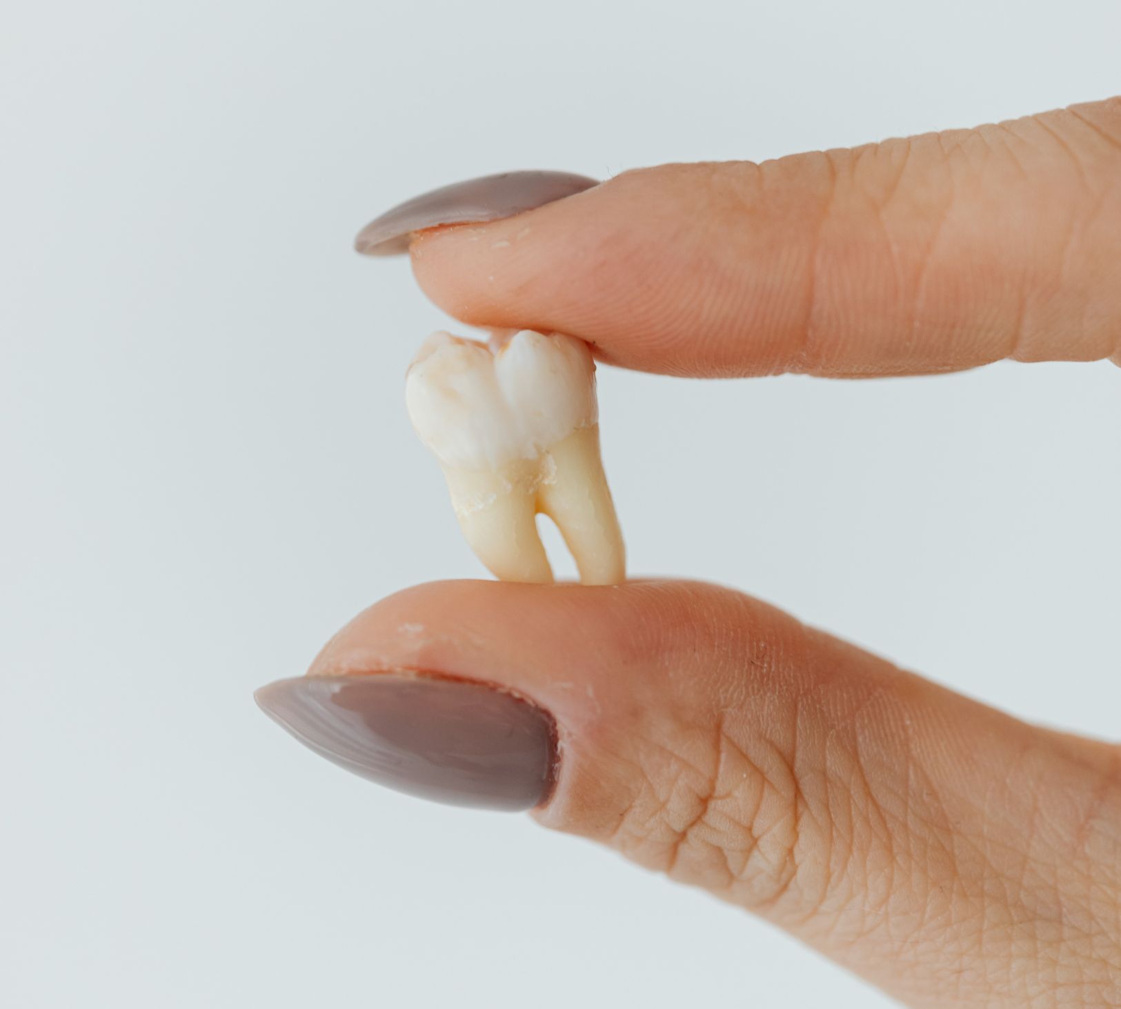 Wisdom Tooth Extraction in Burnaby