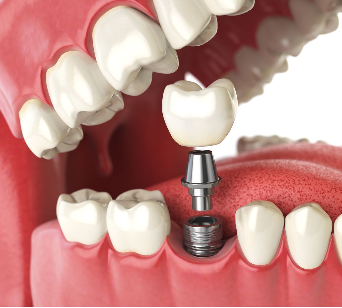 Single Tooth Dental Implants in Burnaby