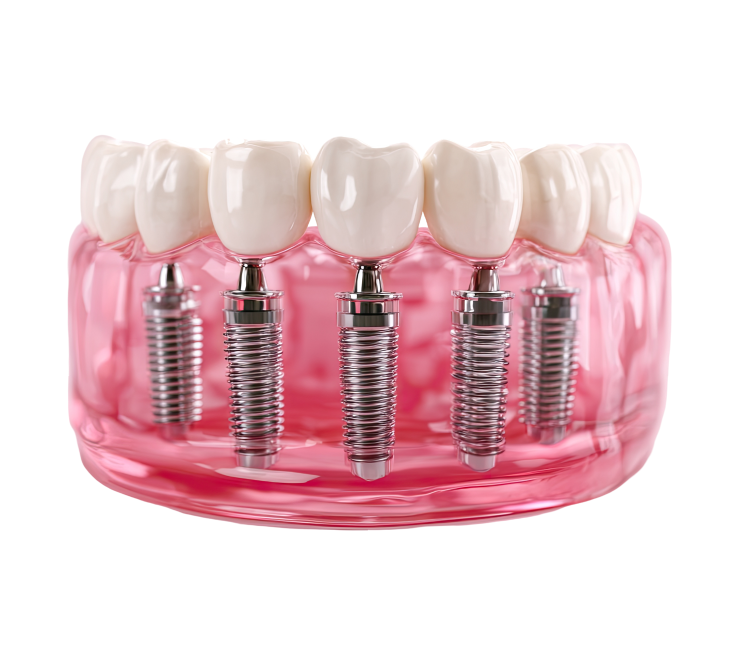 All-on-4 Dental Implants