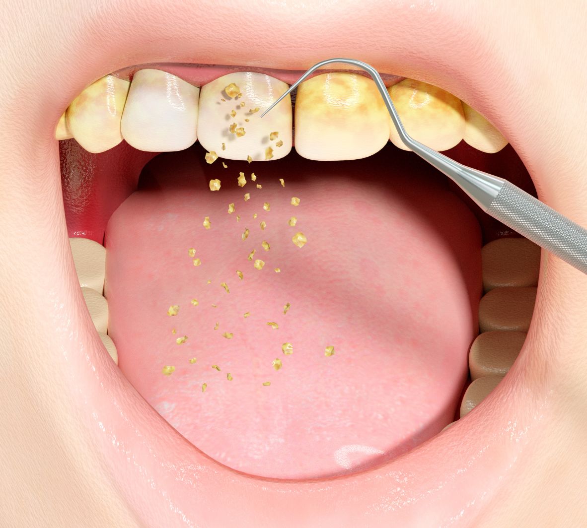 teeth that needs scaling