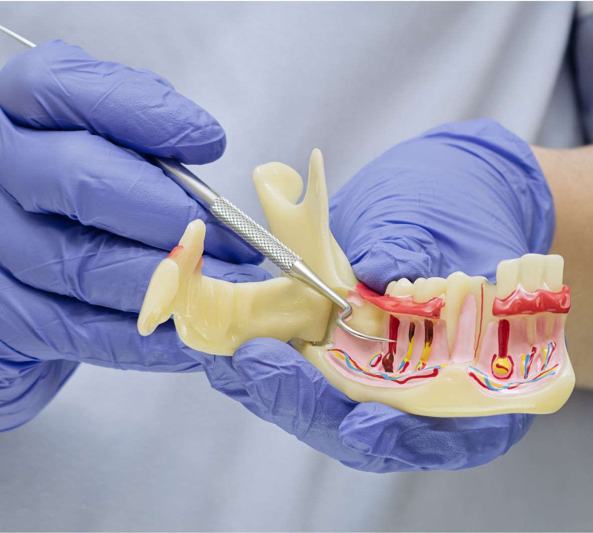 Periodontal Maintenance in Burnaby