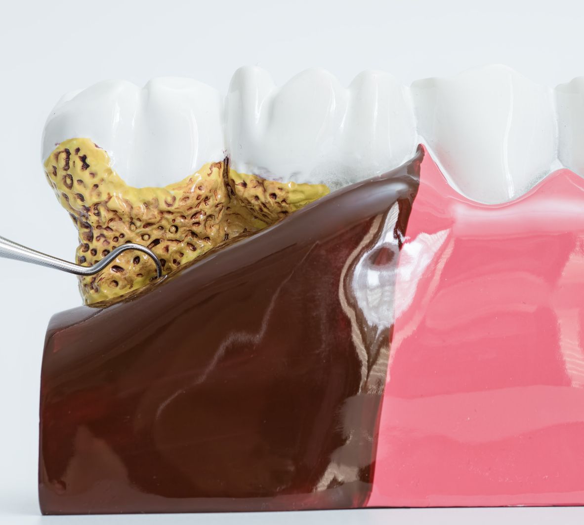 periodontal maintenance for bleeding