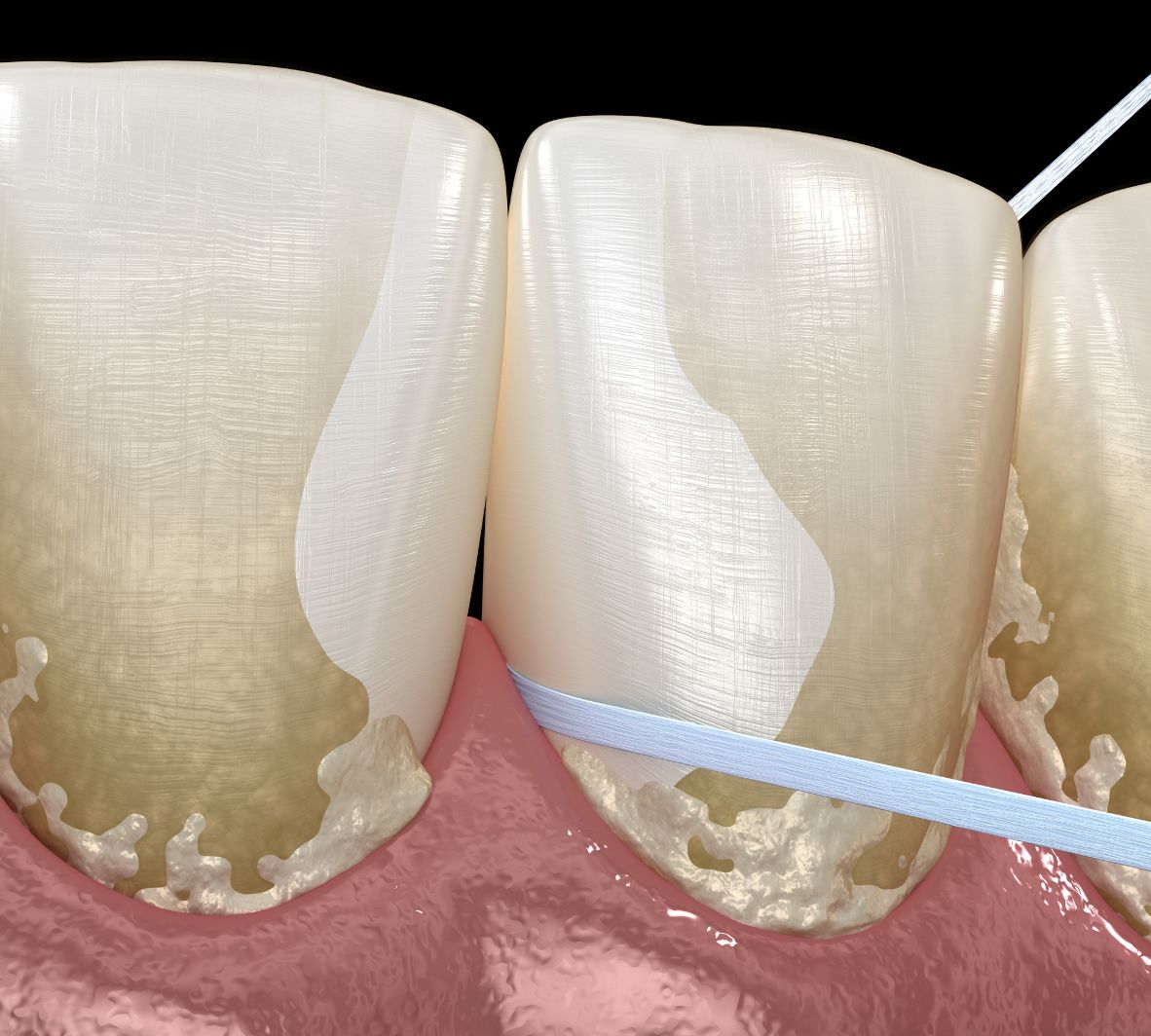teeth needing Periodontal Maintenance in Burnaby