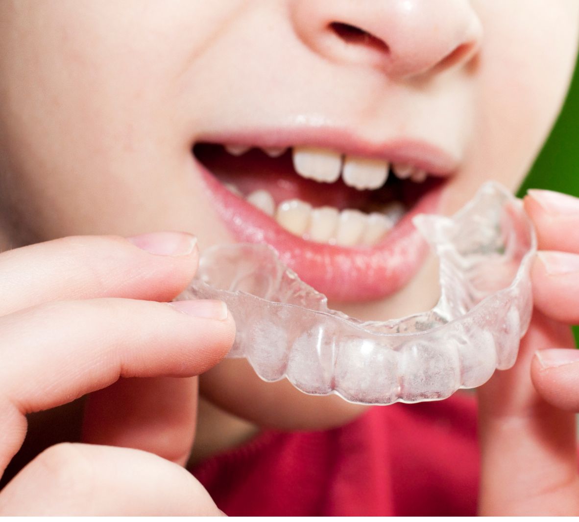 non-surgical solutions like custom nightguards