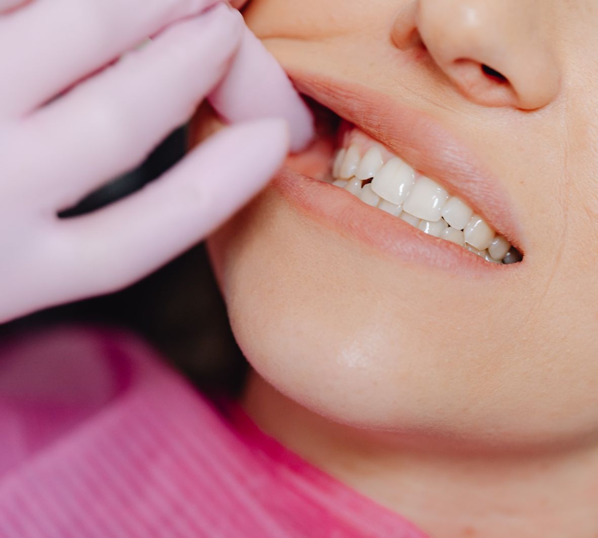 Dental Bonding in Burnaby