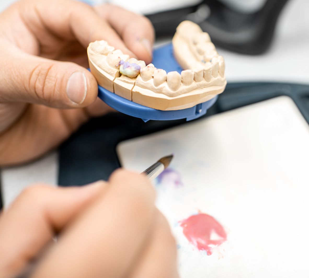 Dental Inlays and Onlays in Burnaby What Are Dental Inlays and Onlays?