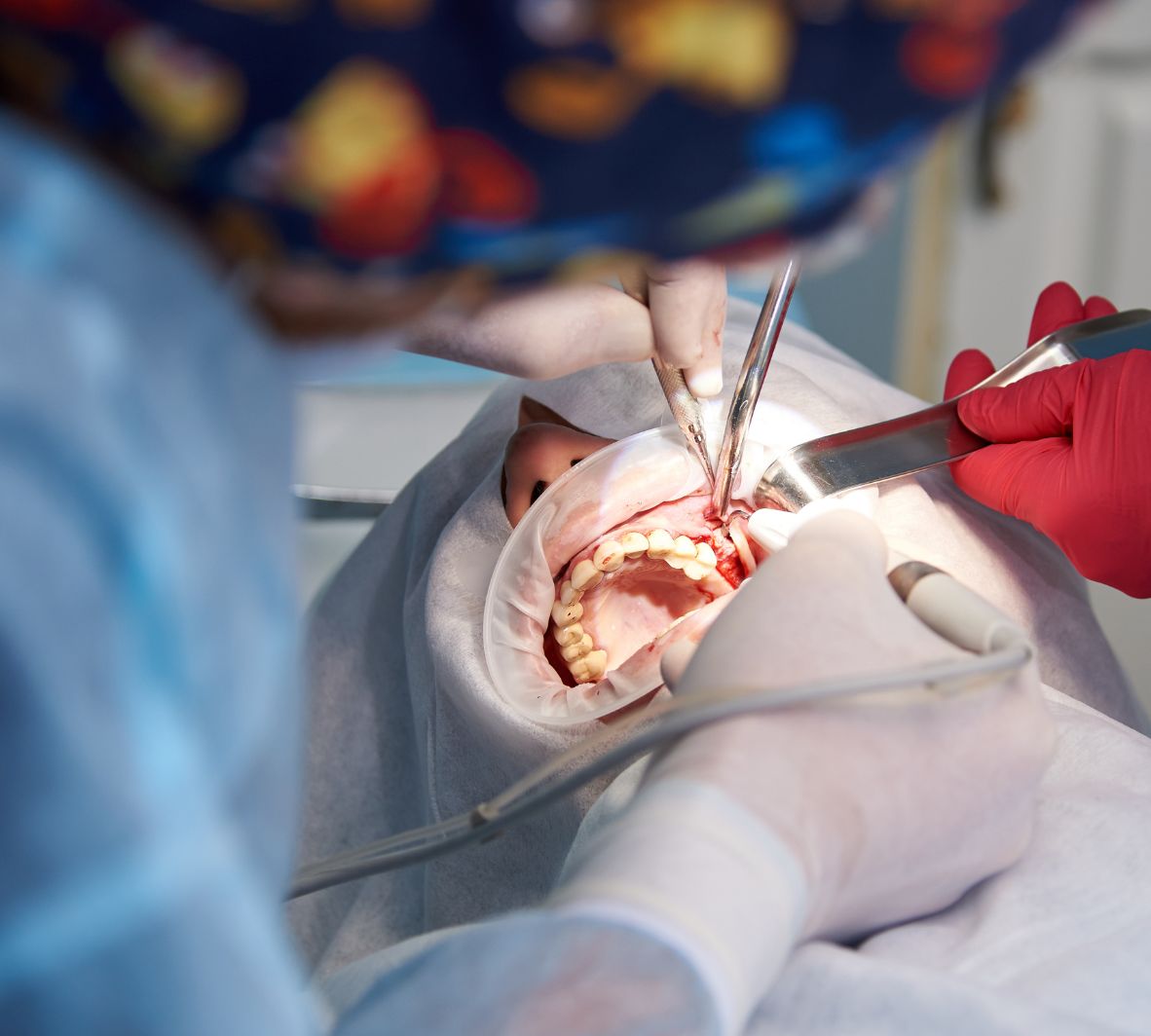 The Sinus and Upper Jaw — Why Bone Height Matters