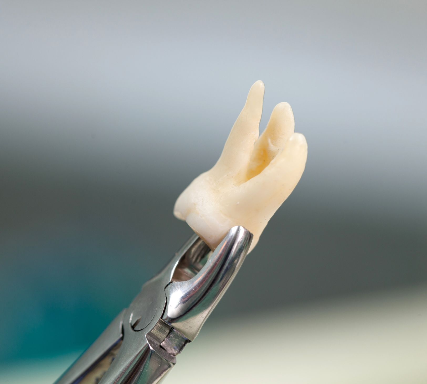 Reasons Wisdom Teeth Cause Problems (And What They Can Damage)