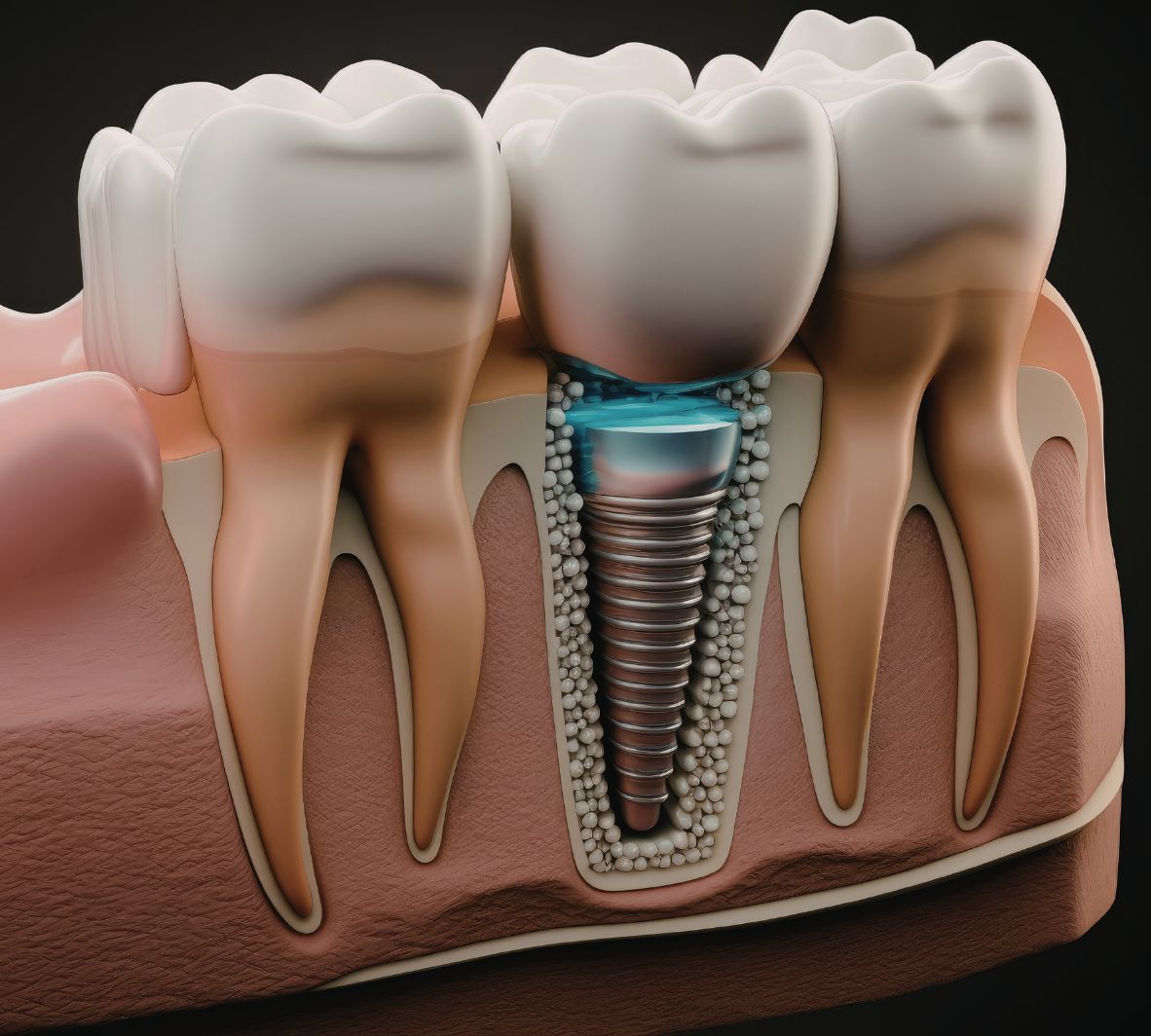How Long Does a Single Tooth Implant Last?
