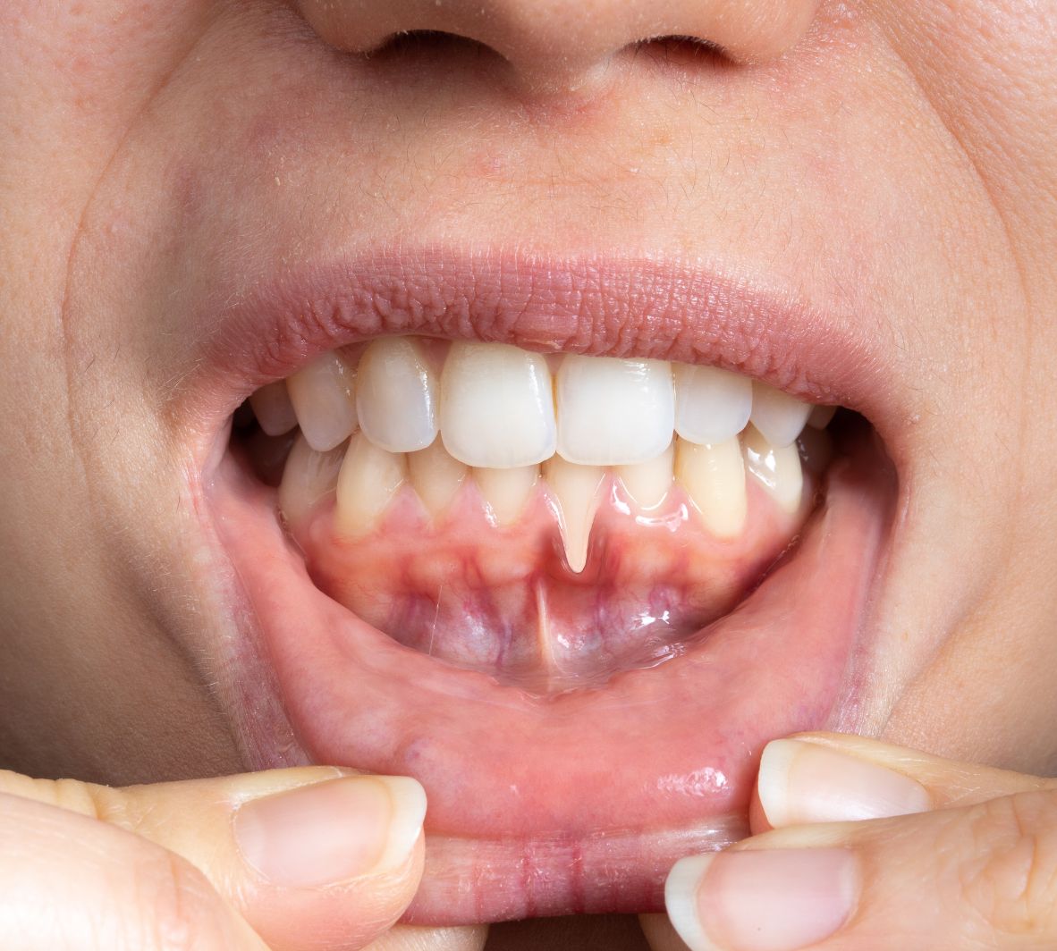 gum grafting in Burnaby