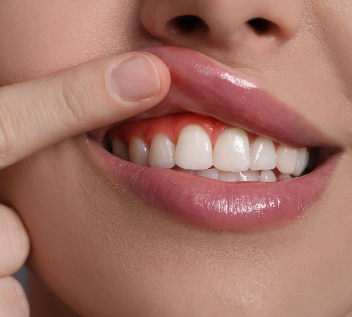 Safety, Risks, and Common Myths About Gum Grafting