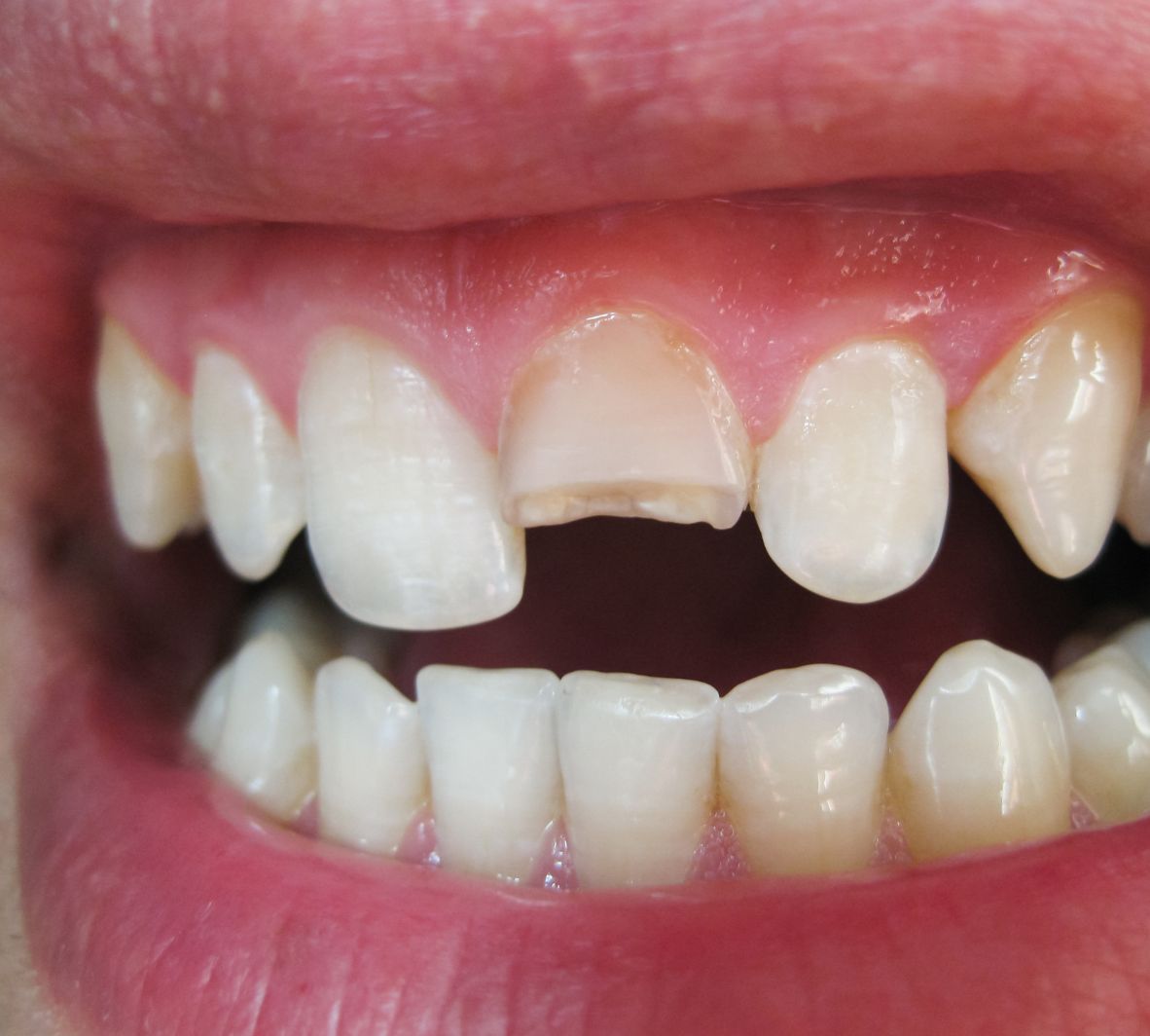 Fix Chips and Cracks Fast with Dental Bonding in Burnaby