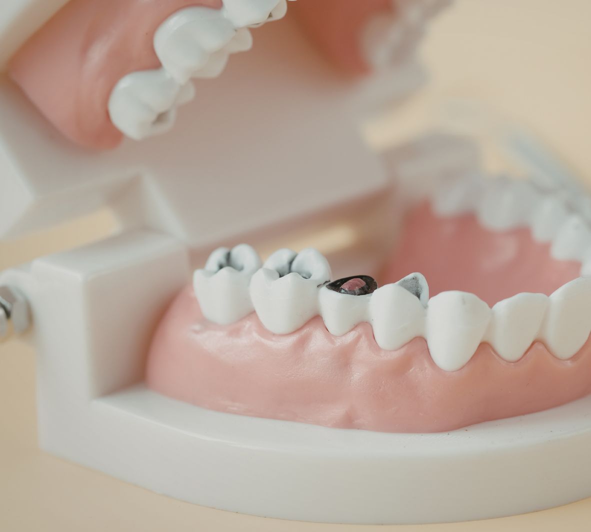 Dental Inlays and Onlays in Burnaby Daily Oral Care and Fluoride Use