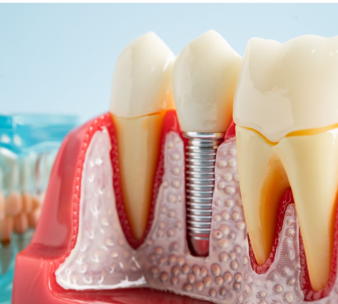 Single Tooth Implant Treatment in Burnaby