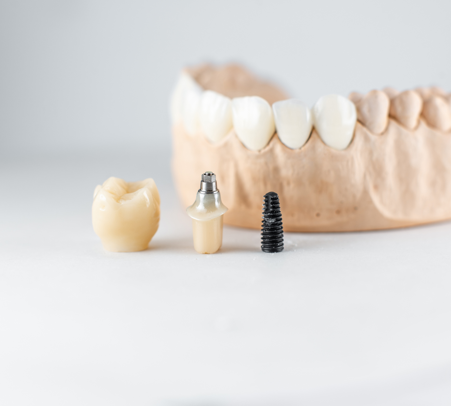 How Long Do All-on-4 Results Last?