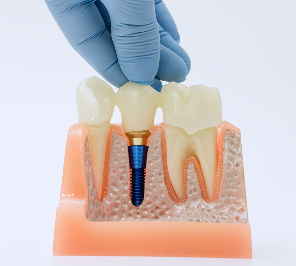 Implant-Supported Restorations in Burnaby