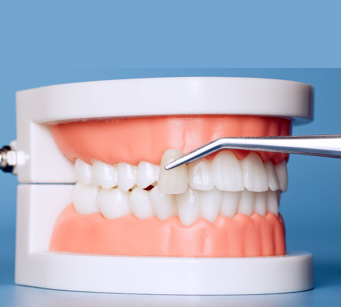 Porcelain Veneers in Burnaby | Cost, Process & Candidacy