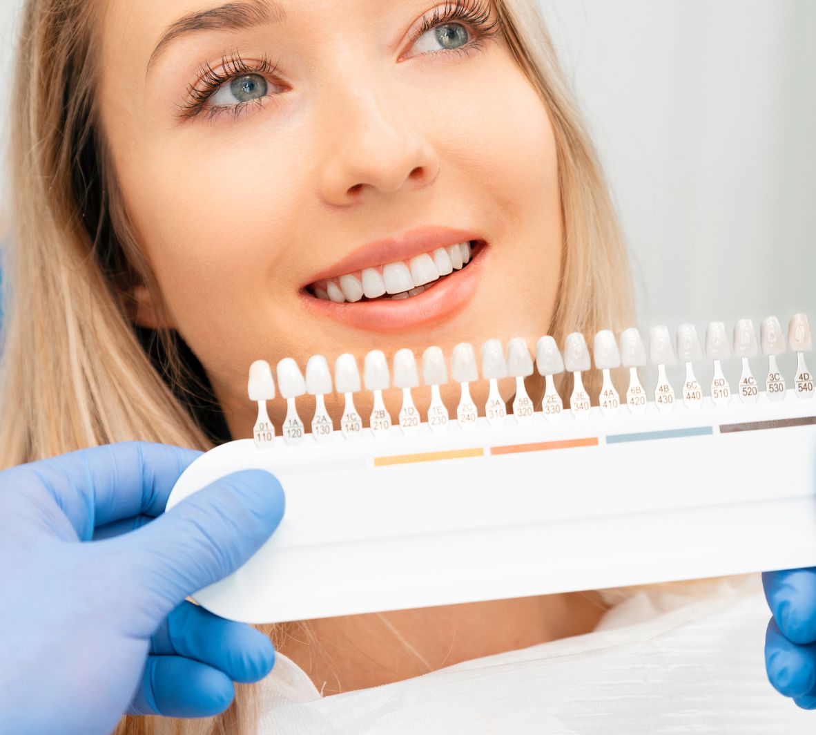 Composite Veneers