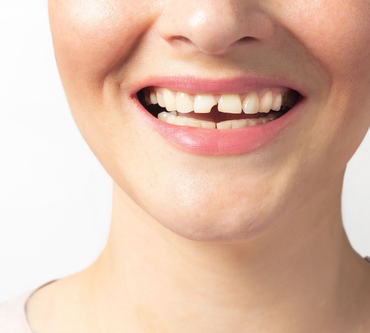 What Is Dental Bonding?
