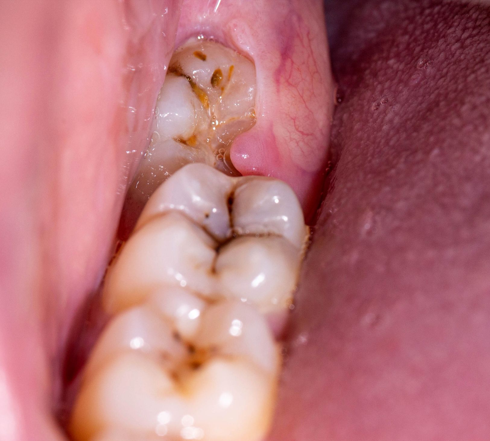 When a Tooth Gets “Stuck” Under the Gum