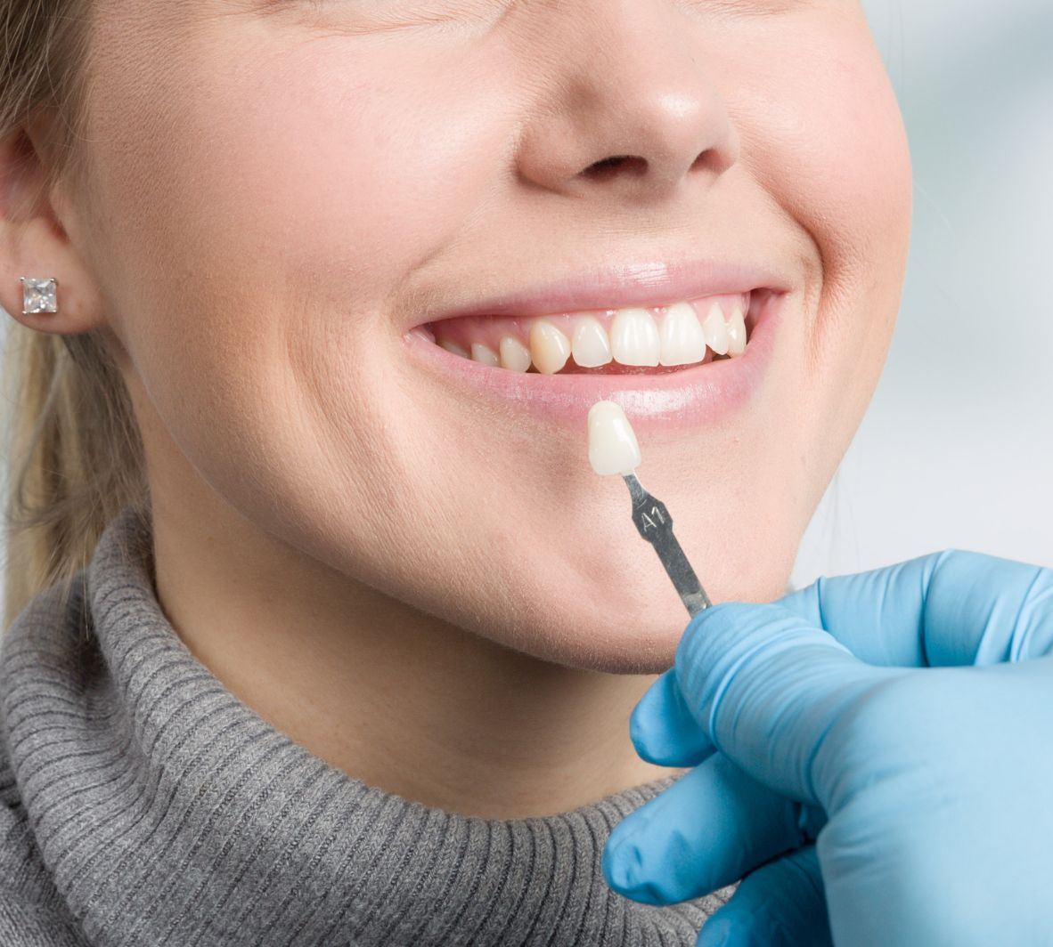 Natural-Looking Composite Veneers in Burnaby