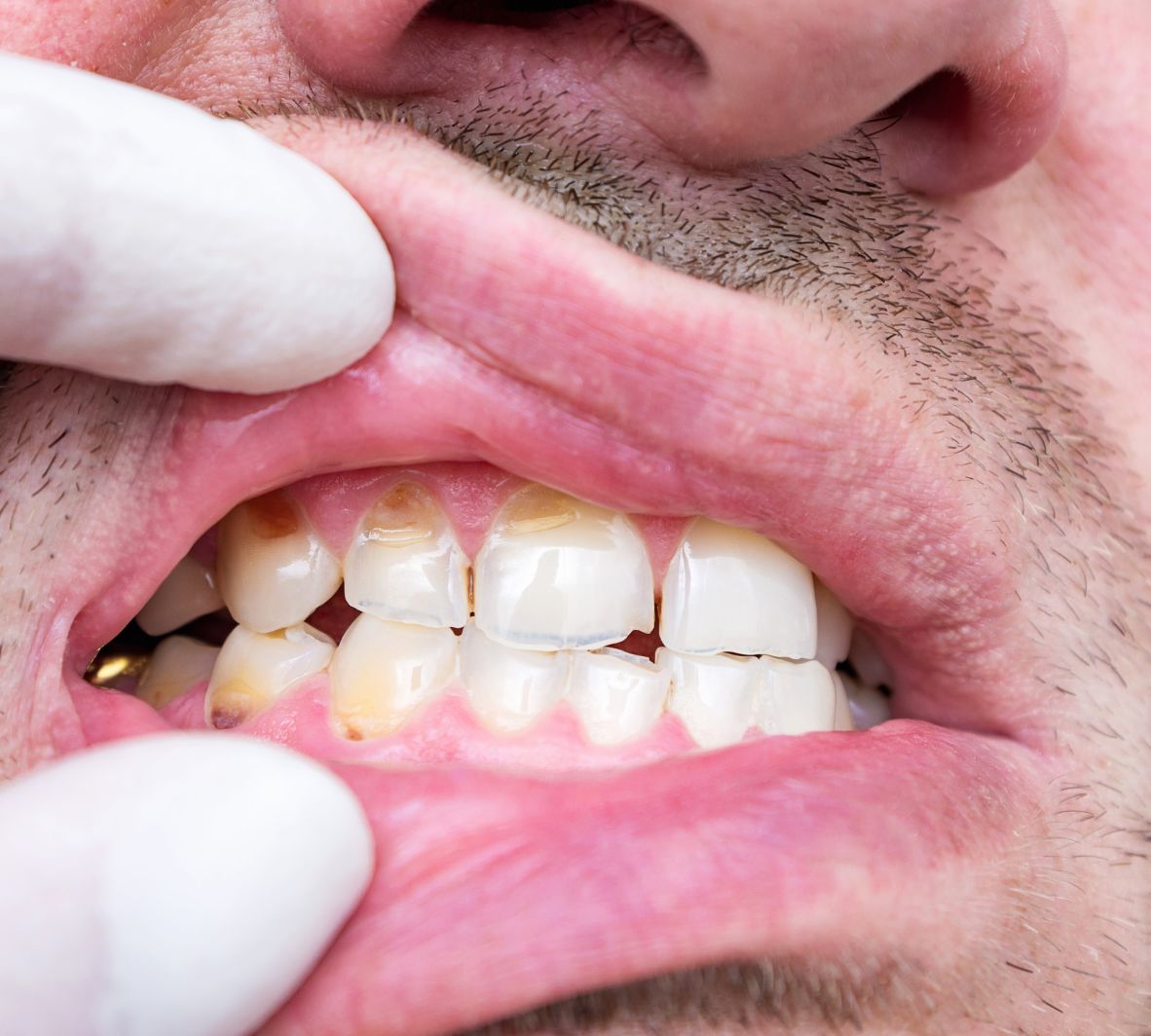 Bonding for Tooth Discoloration and Stains