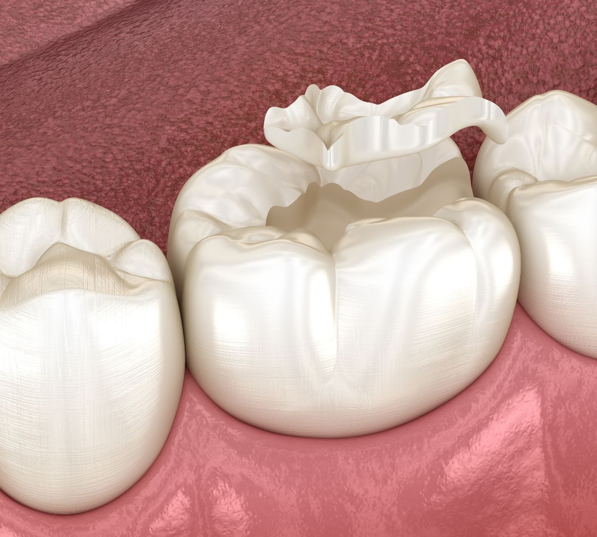 Dental Inlays and Onlays in Burnaby Dental Inlays & Onlays in Burnaby