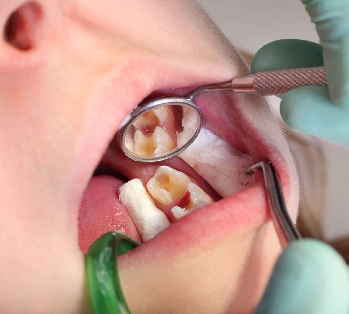 Inlay vs. Onlay – What’s the Difference?