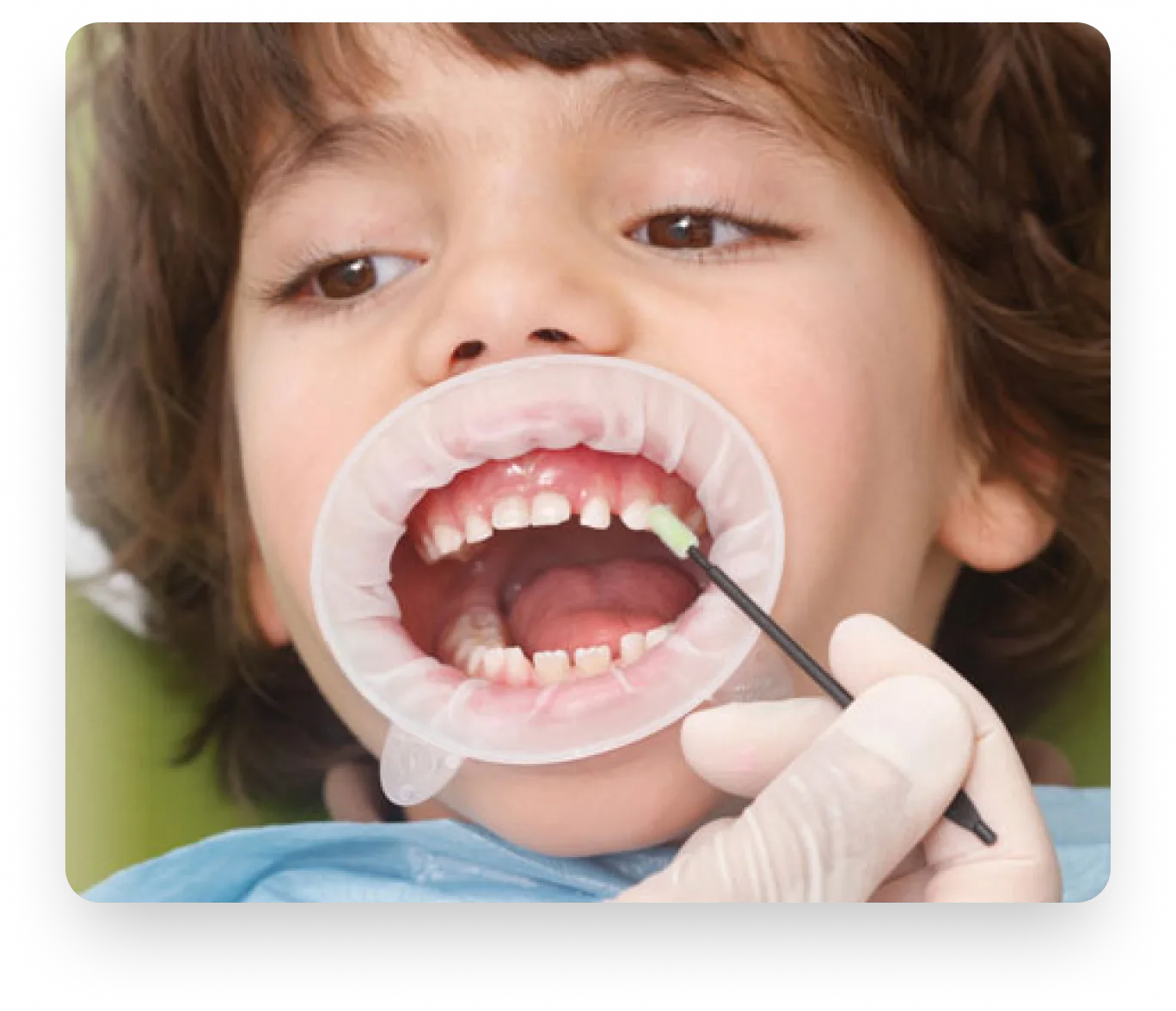 Fluoride Treatment for Kids in Burnaby