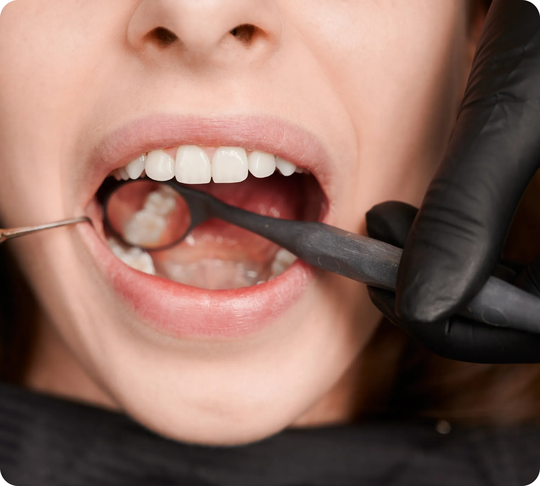 Crown Lengthening Crown Lengthening