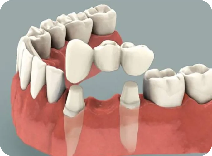 Help Me Fix Missing or Broken Teeth Help Me Fix Missing or Broken Teeth