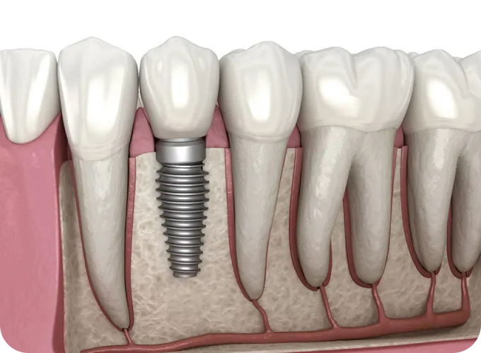 Help Me Fix Missing or Broken Teeth Help Me Fix Missing or Broken Teeth