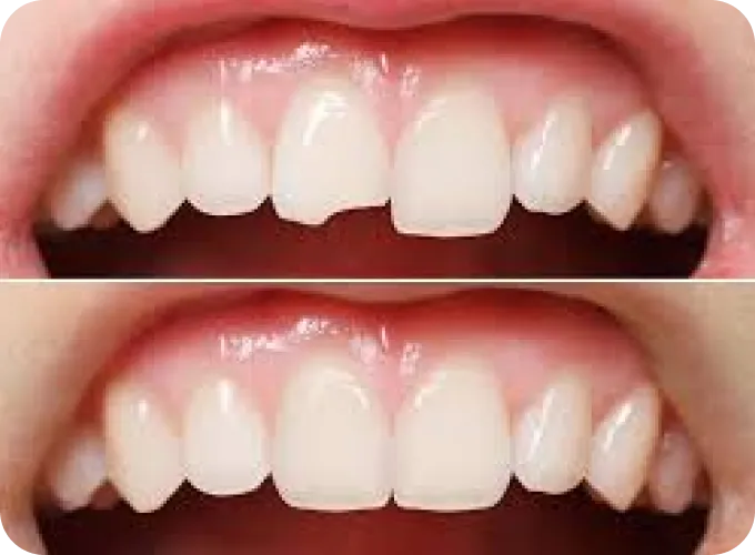 Help Me Fix Missing or Broken Teeth Help Me Fix Missing or Broken Teeth