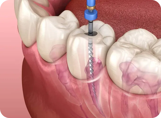 Help Me Fix Missing or Broken Teeth Help Me Fix Missing or Broken Teeth