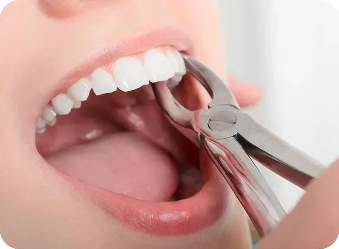 Help Me Fix Missing or Broken Teeth Help Me Fix Missing or Broken Teeth