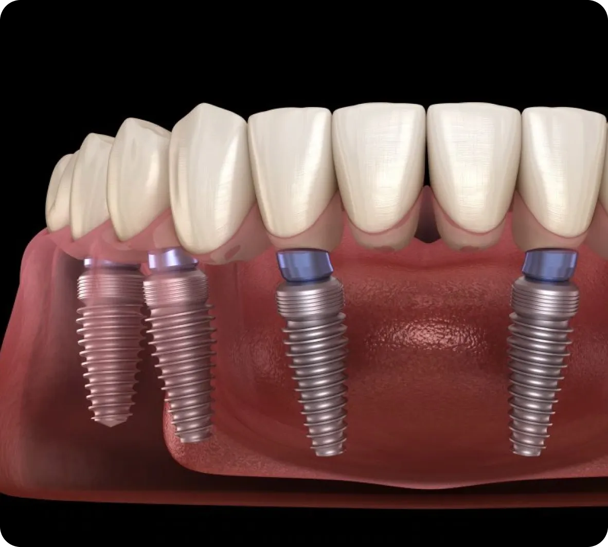 All-on-6 Implant in Burnaby