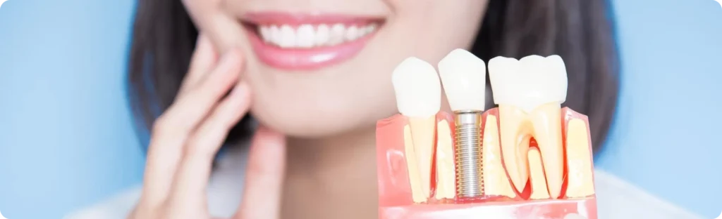 All-on-6 Implant in Burnaby