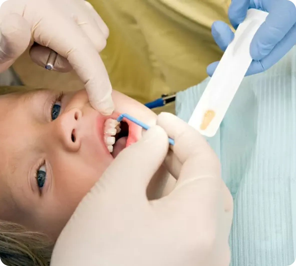 Fluoride Treatment for Kids in Burnaby