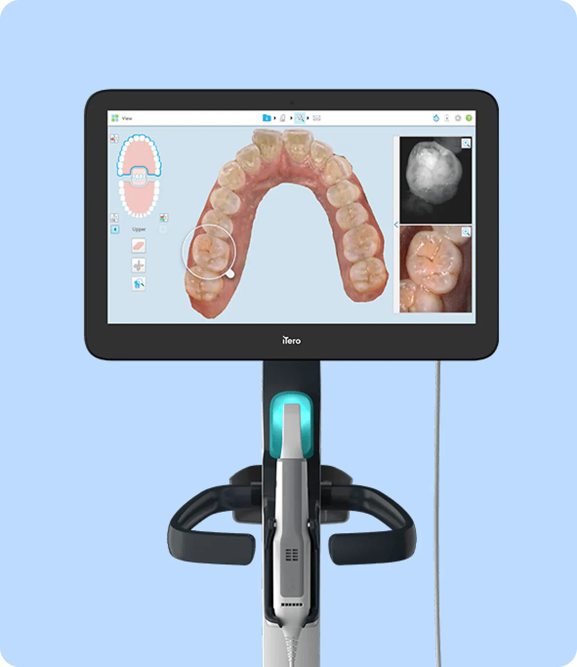 Caries detection devices (iTero, Niri, DIAGNOCat)