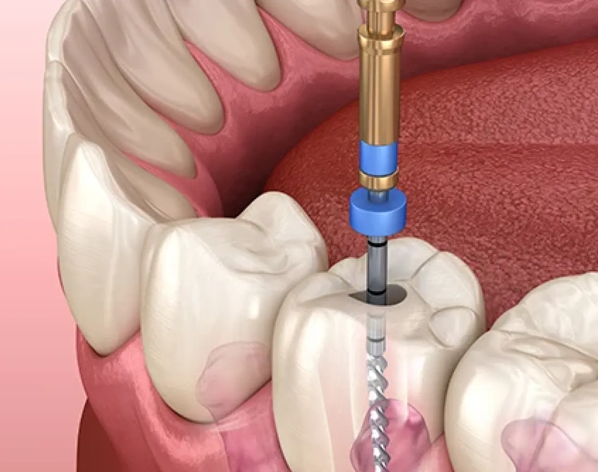 Baby Root Canals in Burnaby