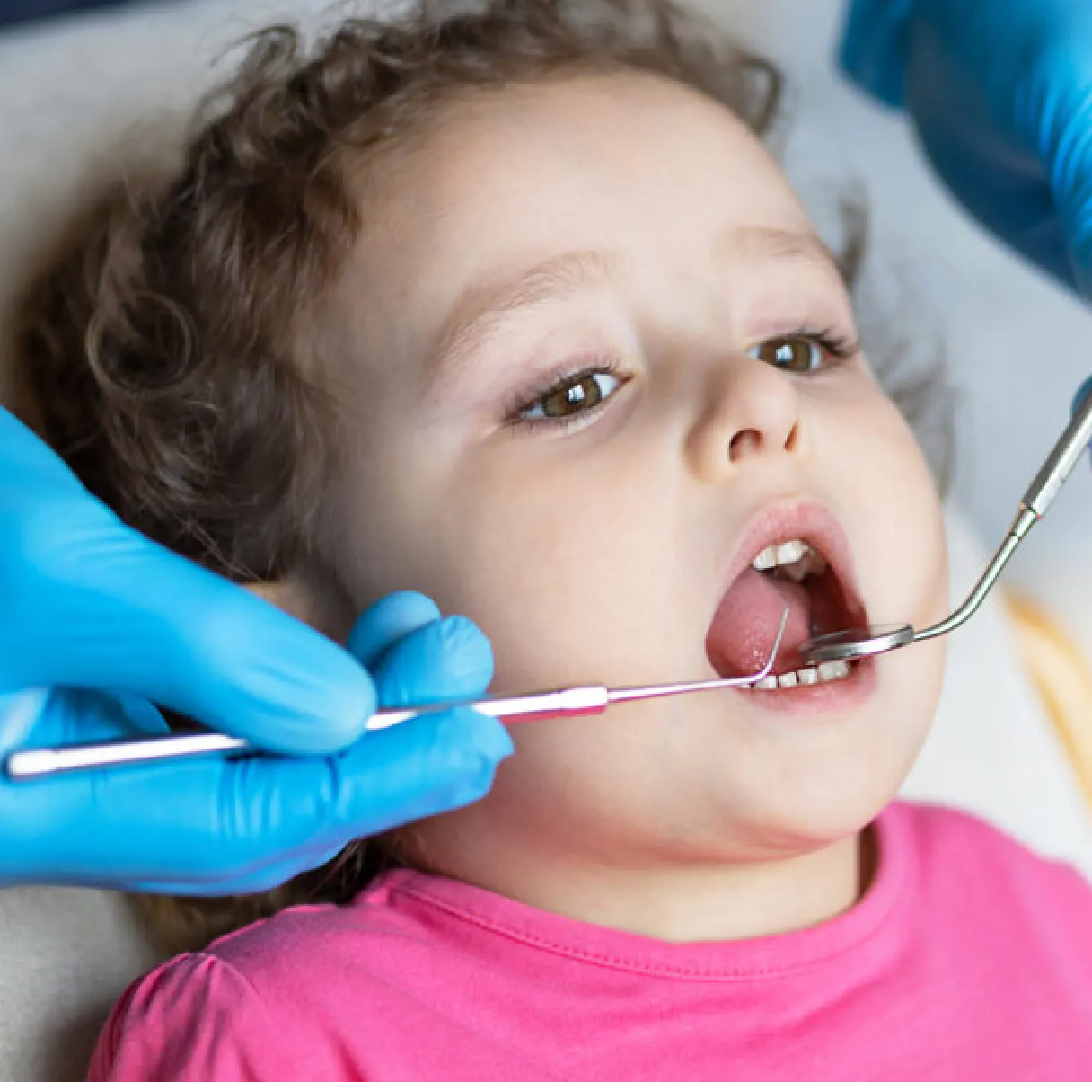 Pulpotomy vs Pulpectomy Pulpotomy vs Pulpectomy