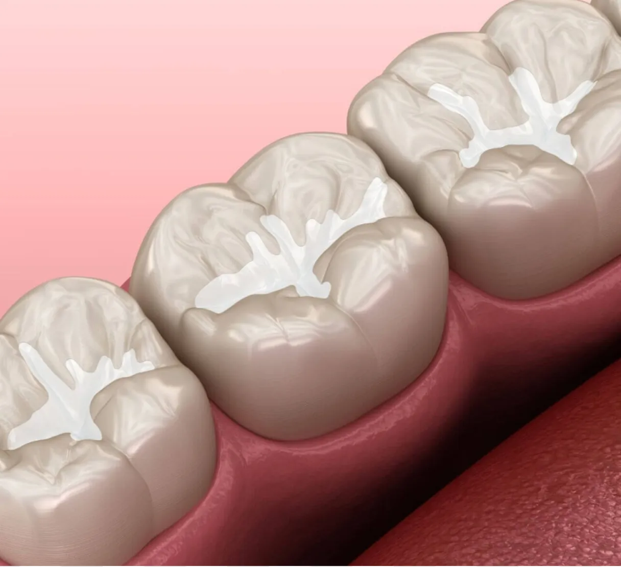 Dental Sealants for Kids in Burnaby Dental Sealants for Kids in Burnaby
