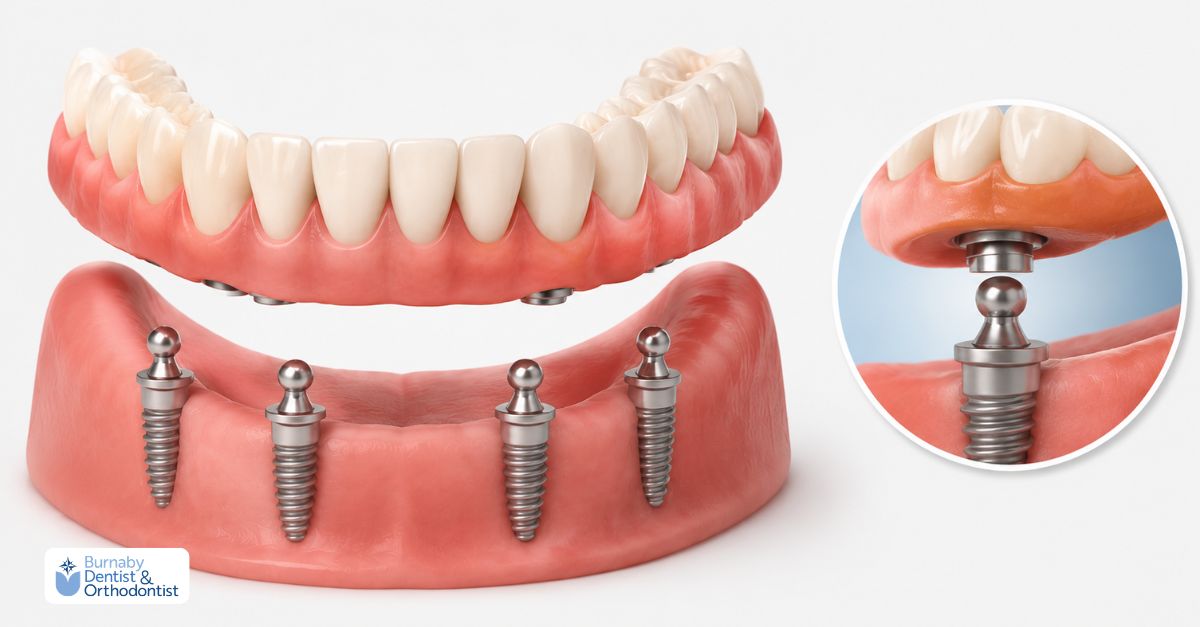  Implant-supported overdenture secured to multiple dental implants