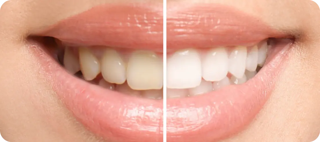 Close-up comparison of teeth before and after whitening treatment