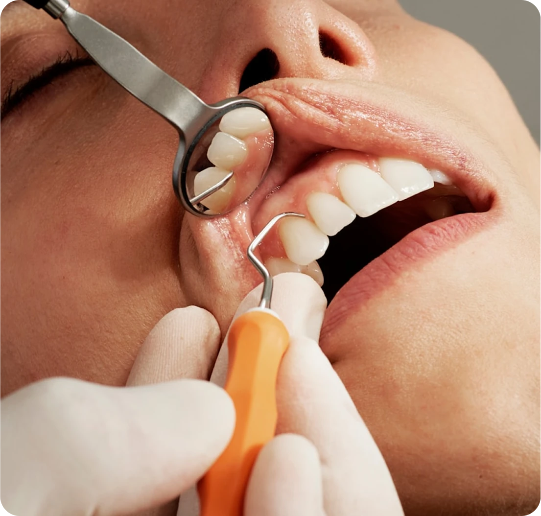 Dentist cleaning plaque from teeth with a dental scaler tool.