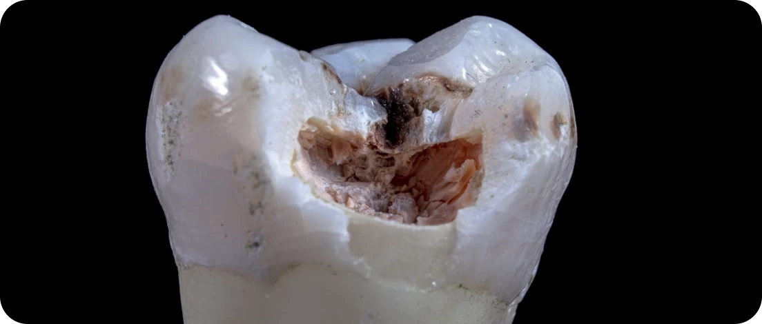 Close-up of a decayed molar tooth with visible cavity and dental damage.