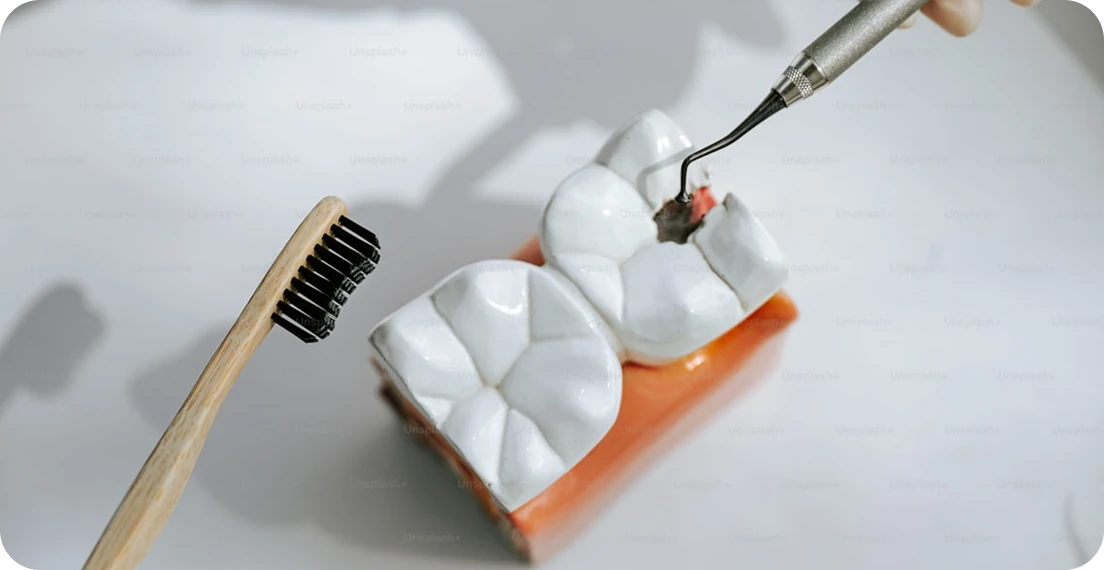 Close-up of dentist applying a filling material to a model of molar teeth
