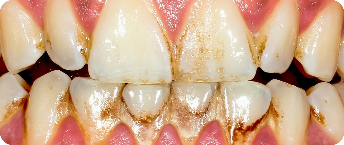 Close-up of stained teeth with heavy tartar buildup