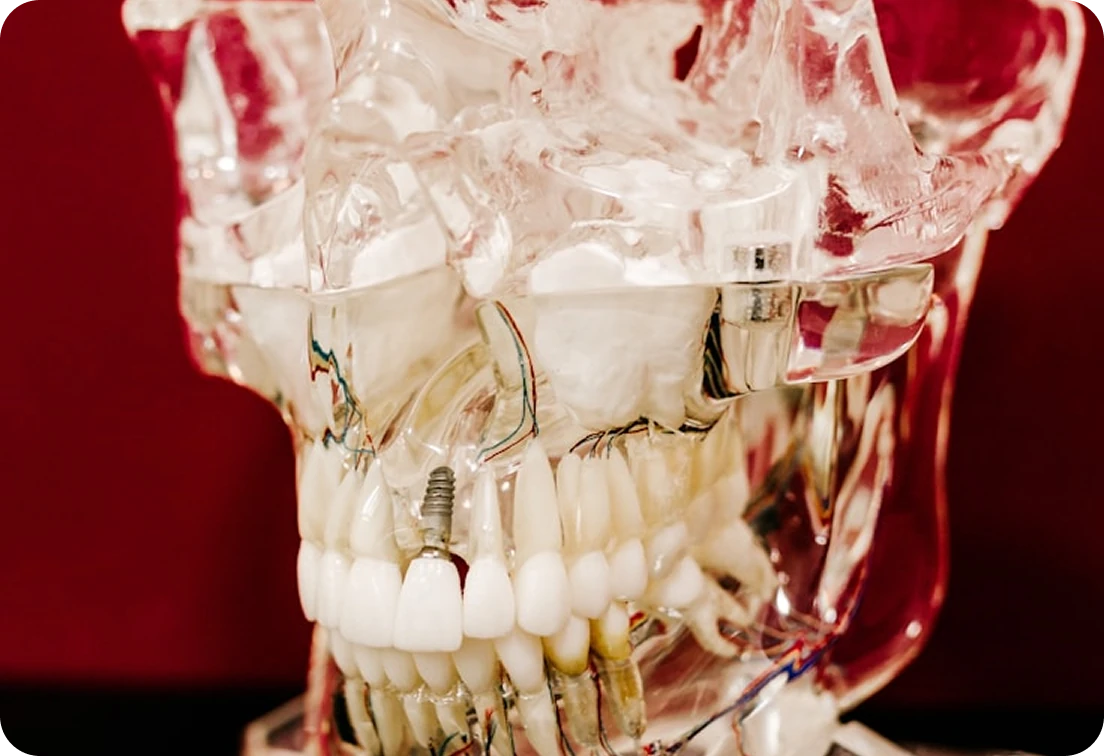 Transparent dental model with implants and orthodontic wires on display