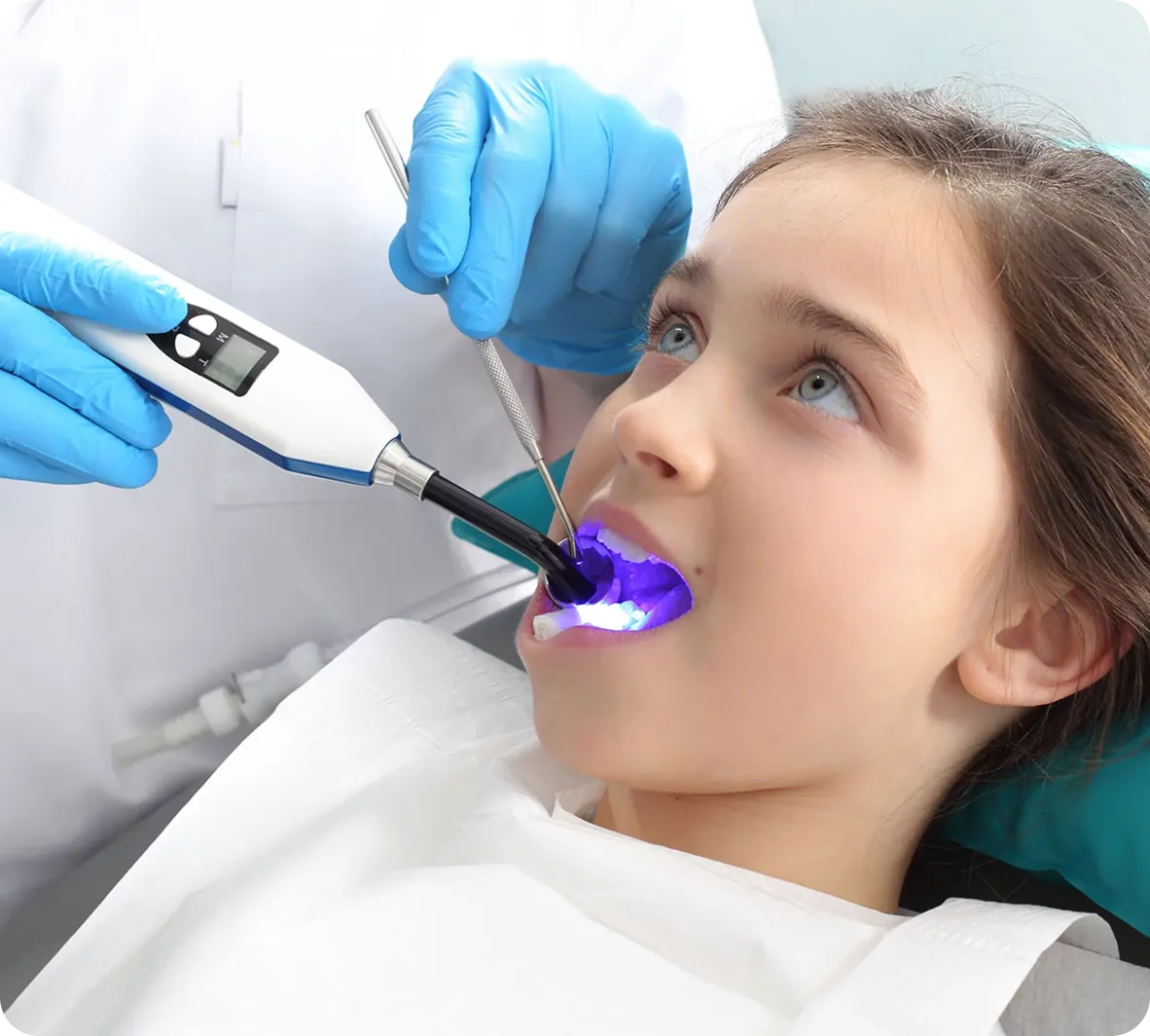 Dental Sealants for Kids in Burnaby Dental Sealants for Kids in Burnaby